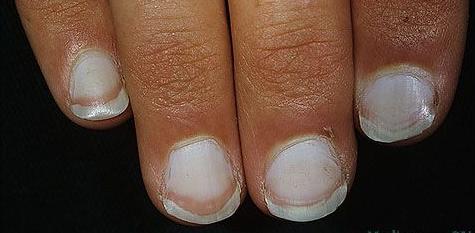 Белые пятна на ногтях причины их возникновения