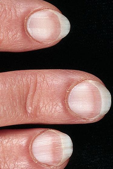 Белое пятно на ногте